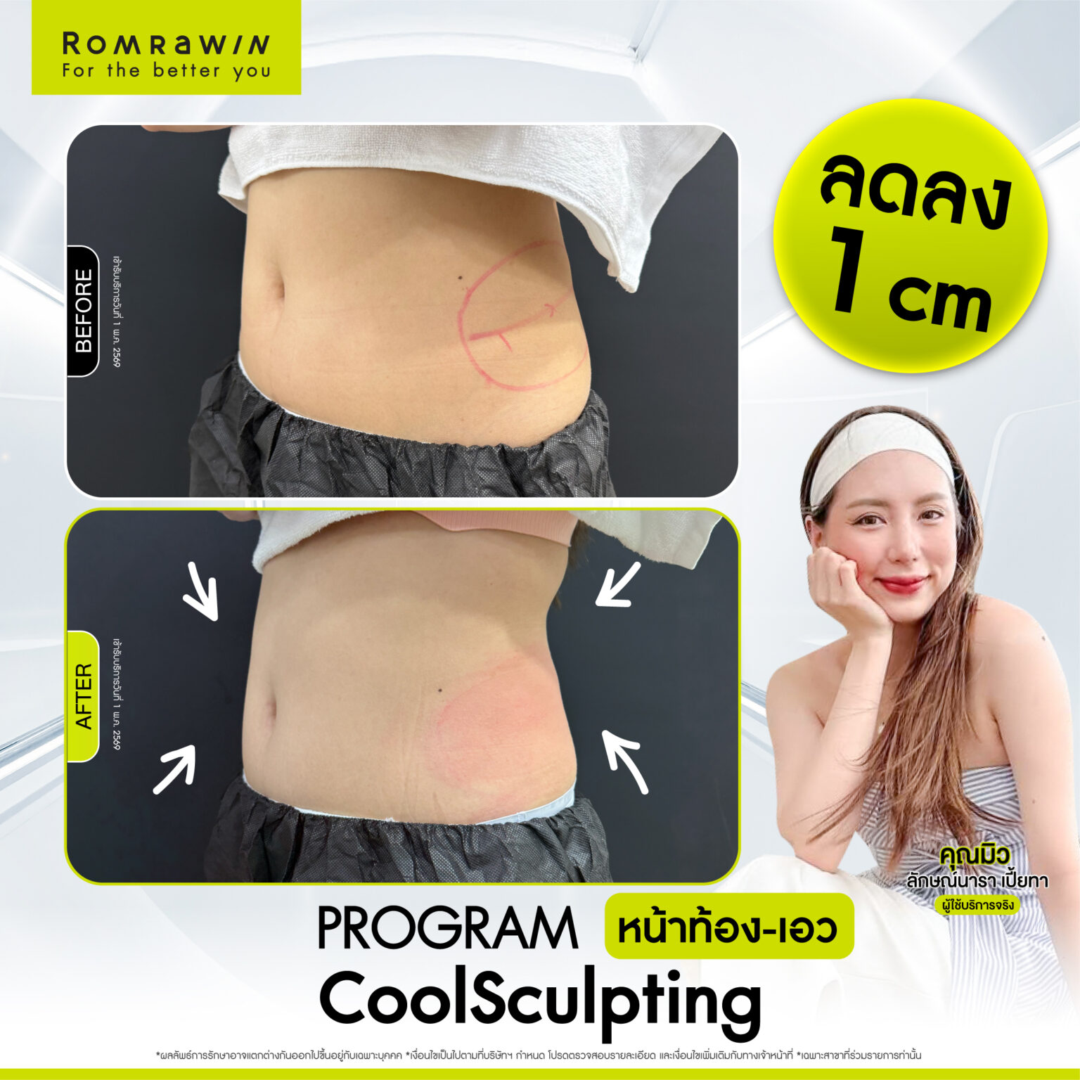 รีวิว Cool Sculpting หน้าท้อง คุณมิว