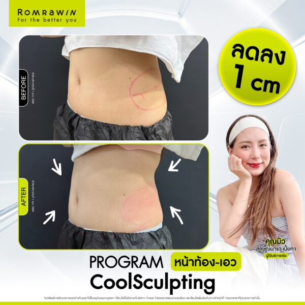 All Review 174 รีวิว Cool Sculpting หน้าท้อง คุณมิว