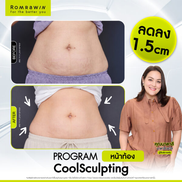 รีวิว Cool Sculpting คุณนาตาลี