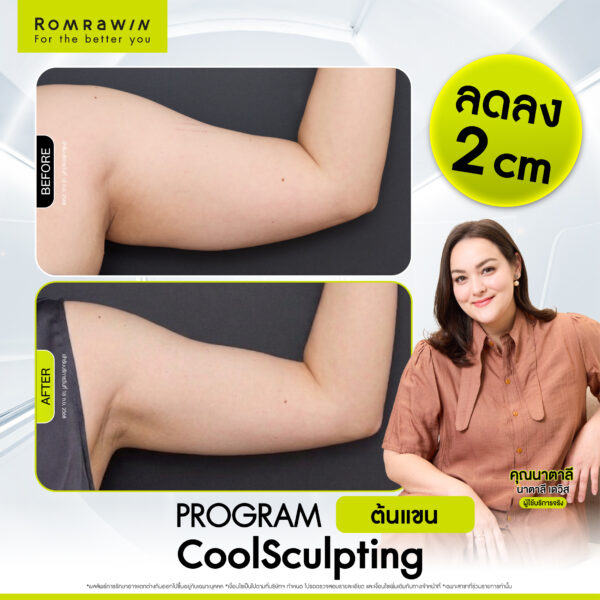 รีวิว Cool Sculpting คุณนาตาลี