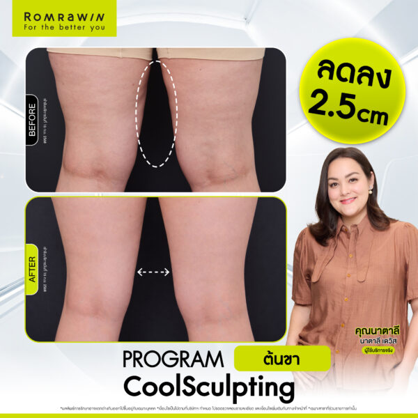รีวิว Cool Sculpting คุณนาตาลี