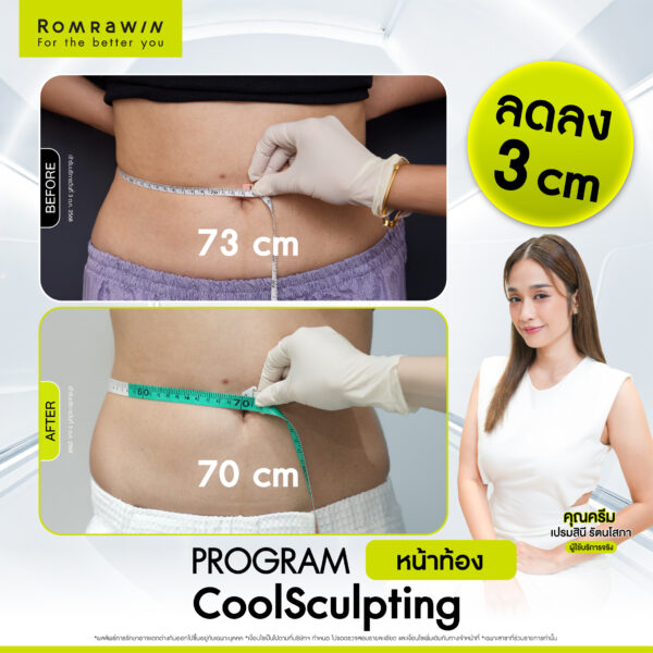 รีวิว Cool Sculpting คุณครีม