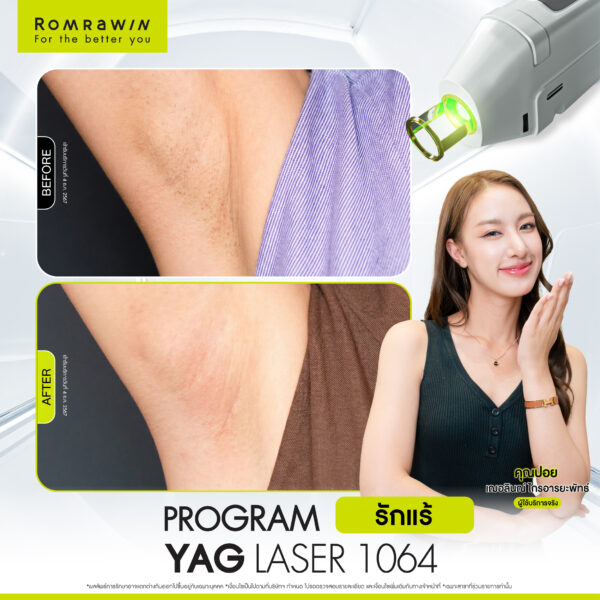 รีวิว Yag Laser 1064 คุณปอย