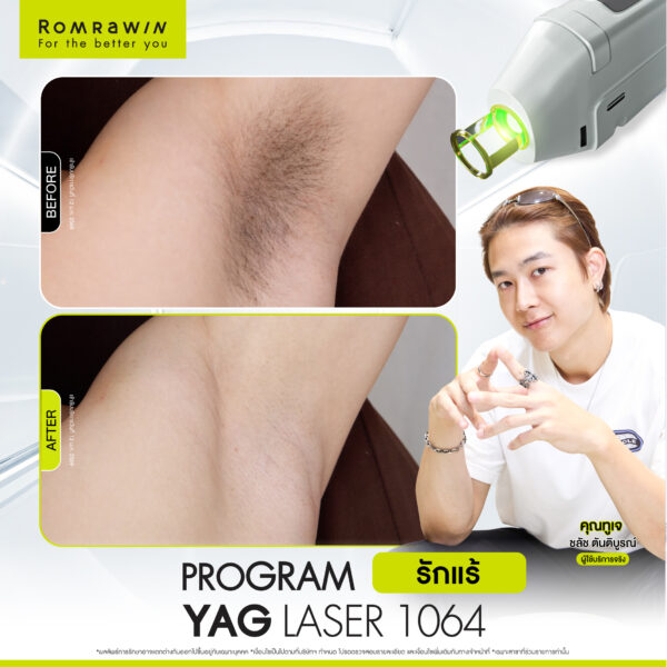 All Review 103 รีวิว Yag Laser 1064 คุณทูเจ