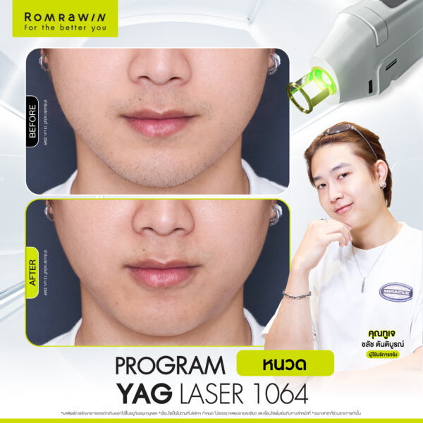 All Review 116 รีวิว Yag Laser 1064 หนวด คุณทูเจ