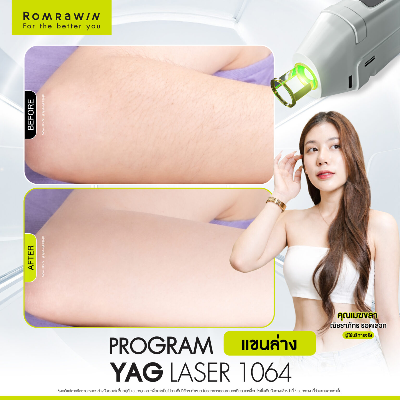 รีวิว Yag Laser 1064 แขนล่าง คุณเมฆลา