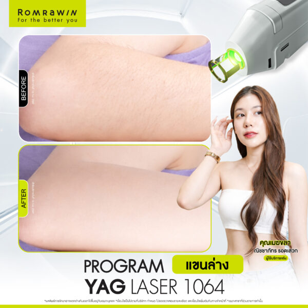 All Review 100 รีวิว Yag Laser 1064 แขนล่าง คุณเมฆลา
