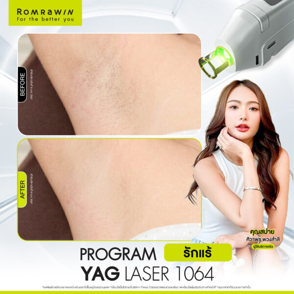 All Review 104 รีวิว Yag Laser 1064 คุณสปาย
