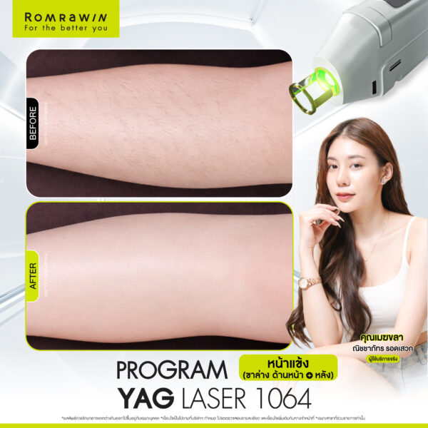 รีวิว Yag Laser 1064 หน้าแข้ง คุณเมฆลา
