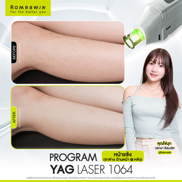 All Review 98 รีวิว Yag Laser 1064 หน้าแข้ง คุณไข่มุก