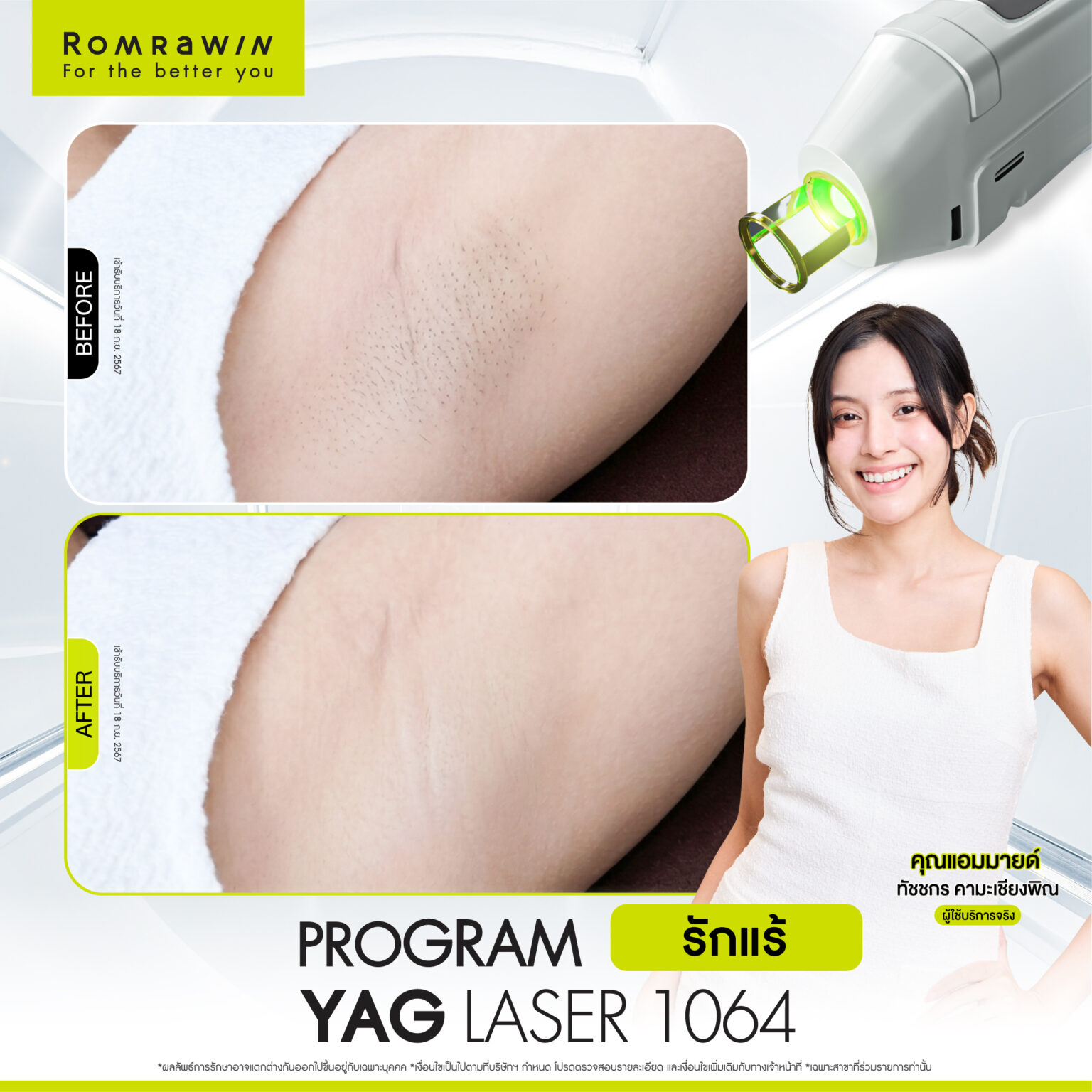 รีวิว Yag Laser 1064 คุณแอมมายด์