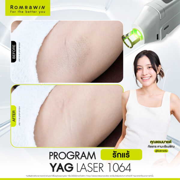 All Review 105 รีวิว Yag Laser 1064 คุณแอมมายด์