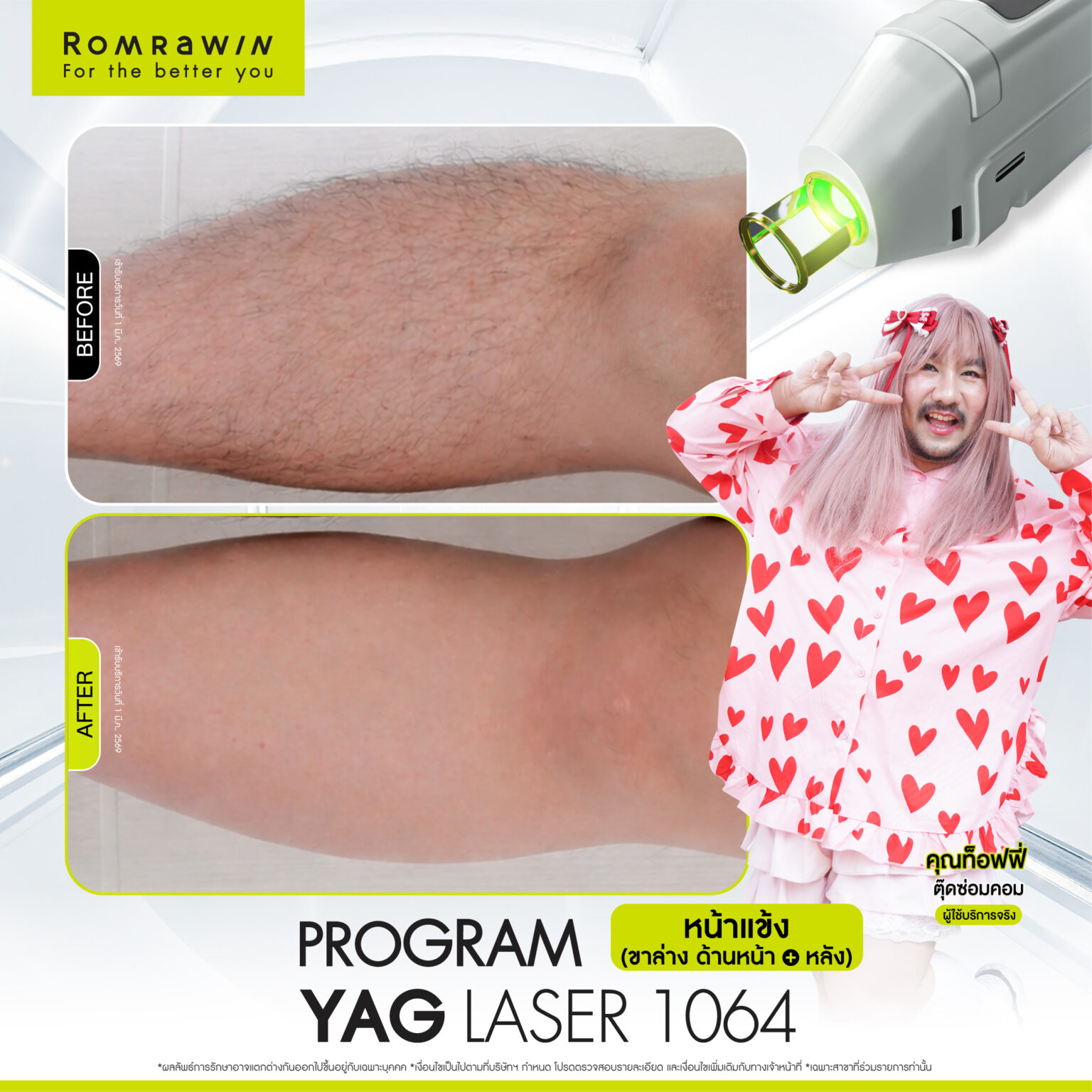 รีวิว Yag Laser 1064 หน้าแข้ง คุณท๊อฟฟี่