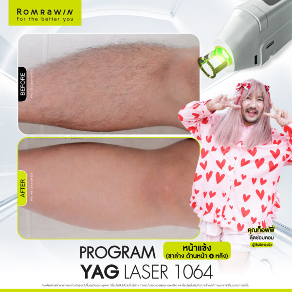 All Review 99 รีวิว Yag Laser 1064 หน้าแข้ง คุณท๊อฟฟี่