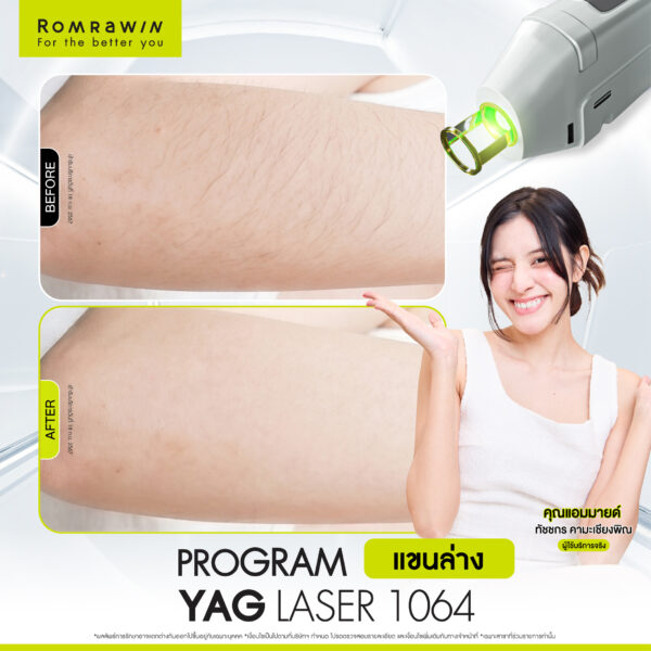 รีวิว Yag Laser 1064 แขนล่าง คุณแอมมายด์