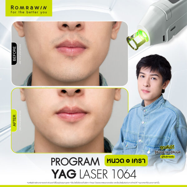 All Review 114 รีวิว Yag Laser 1064 หนวด คุณตังโก้