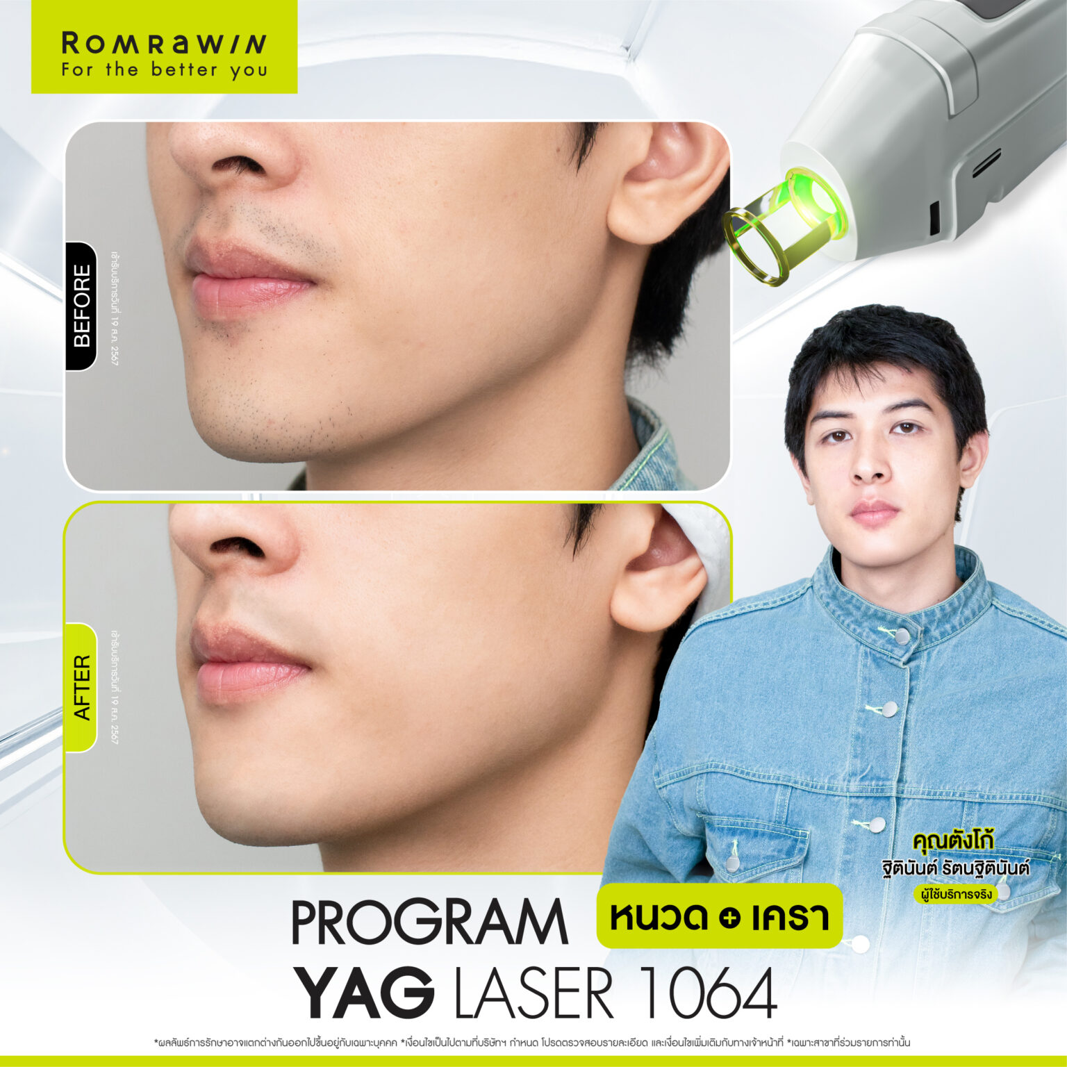 รีวิว Yag Laser 1064 หนวด คุณตังโก้
