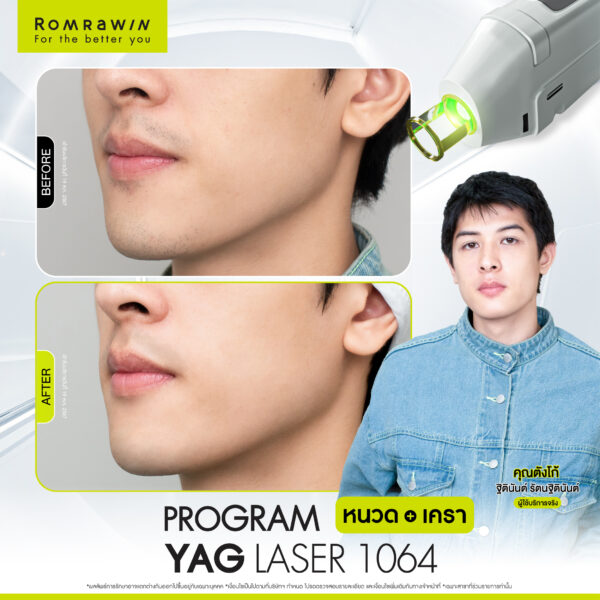 All Review 115 รีวิว Yag Laser 1064 หนวด คุณตังโก้