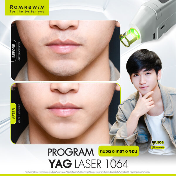 All Review 112 รีวิว Yag Laser 1064 หนวด คุณแอล