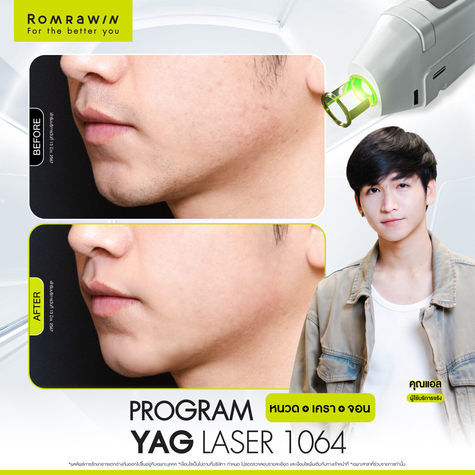 รีวิว Yag Laser 1064 หนวด คุณแอล