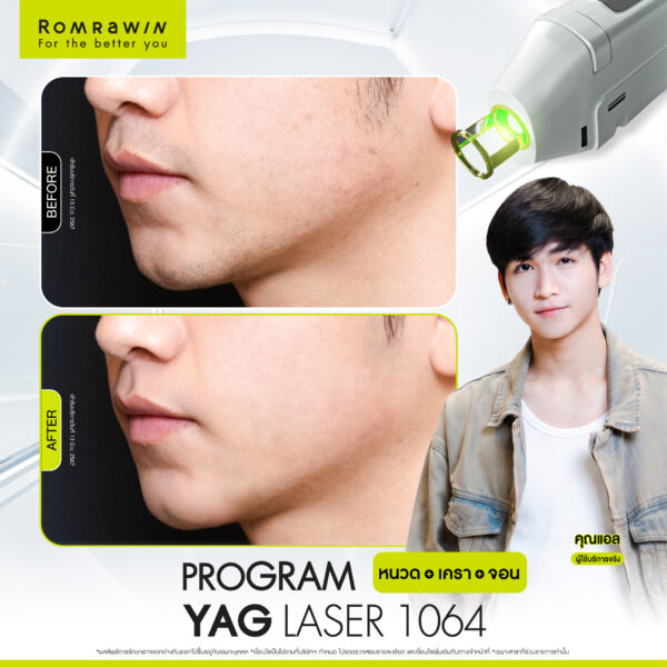 All Review 113 รีวิว Yag Laser 1064 หนวด คุณแอล