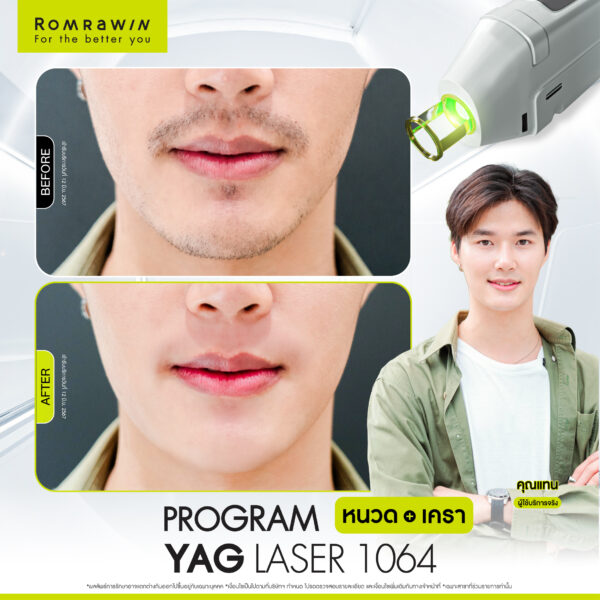 All Review 106 รีวิว Yag Laser 1064 หนวด คุณแทน