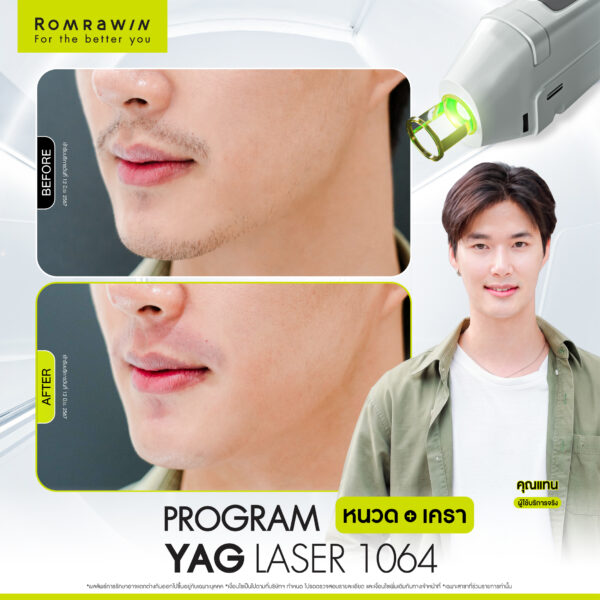 All Review 107 รีวิว Yag Laser 1064 หนวด คุณแทน