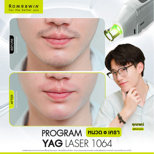 รีวิว Yag Laser 1064 หนวด คุณกรณ์