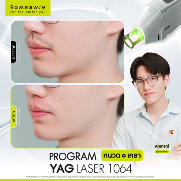 All Review 109 รีวิว Yag Laser 1064 หนวด คุณกรณ์