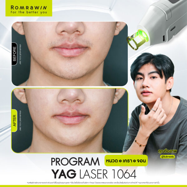All Review 110 รีวิว Yag Laser 1064 หนวด คุณก้องภพ