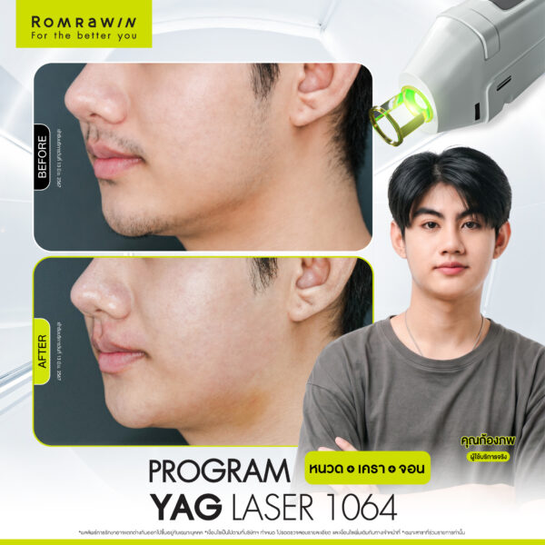 All Review 111 รีวิว Yag Laser 1064 หนวด คุณก้องภพ