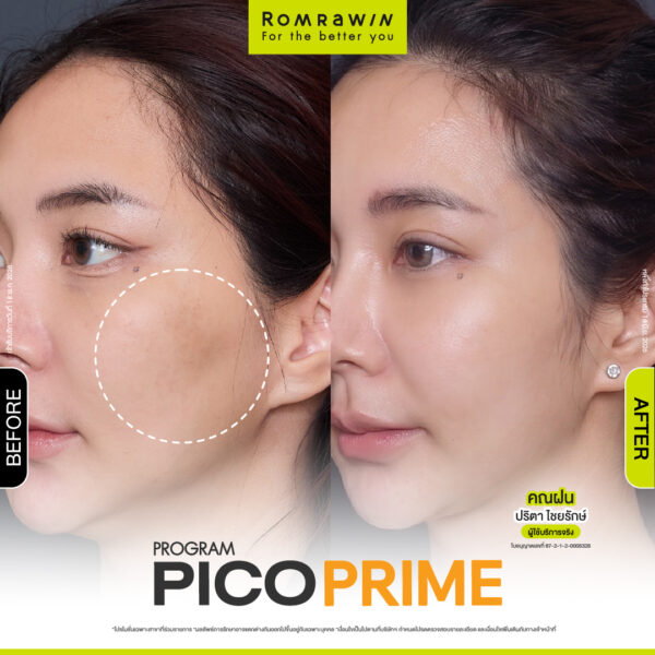 รีวิว Pico Prime คุณฝน