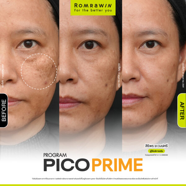 รีวิว Pico Prime คุณสิริพร