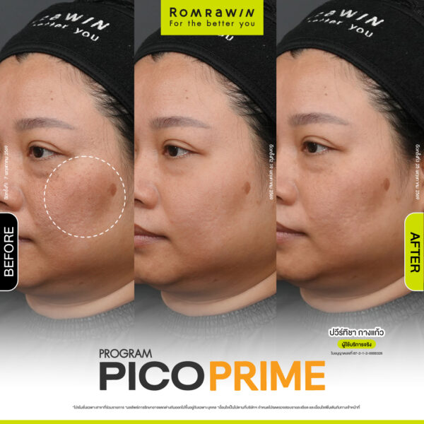 รีวิว Pico Prime คุณปวีร์ทิชา
