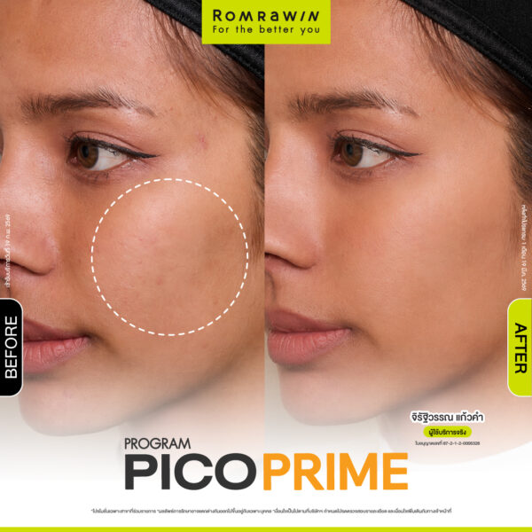 รีวิว Pico Prime คุณจิรัฐวรรณ