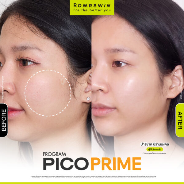 รีวิว Pico Prime คุณปาริชาต