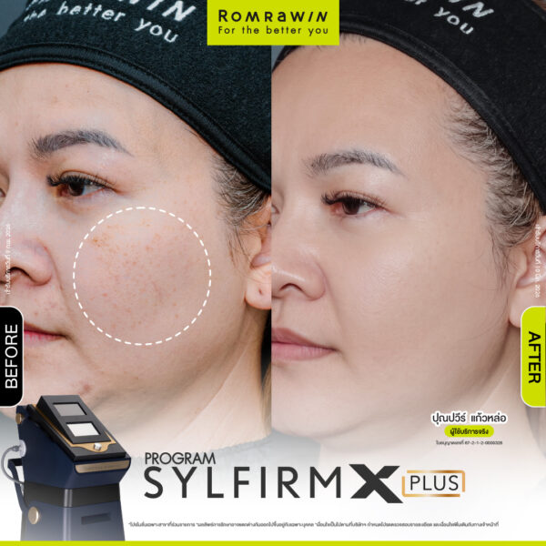 รีวิว Sylfirm X Plus คุณปุณปวีร์