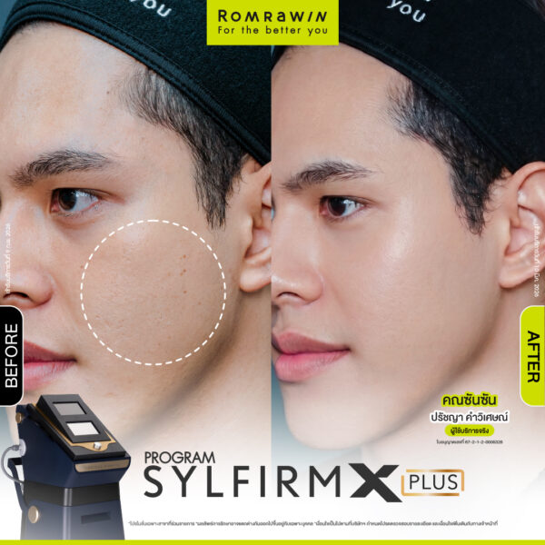 รีวิว Sylfirm X Plus คุณซันซัน