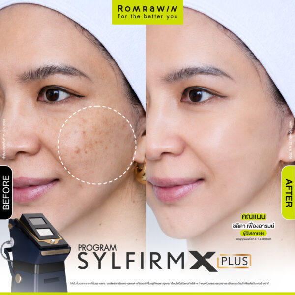 รีวิว Sylfirm X Plus คุณแนน
