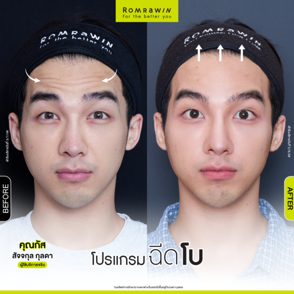 รีวิวโปรแกรมฉีดโบหน้าผาก คุณกัส