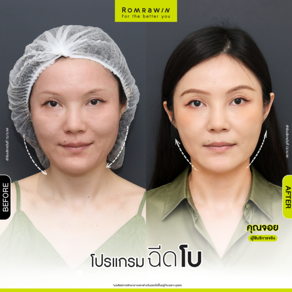 All Review 199 รีวิวโปรแกรมฉีดโบกราม คุณจอย