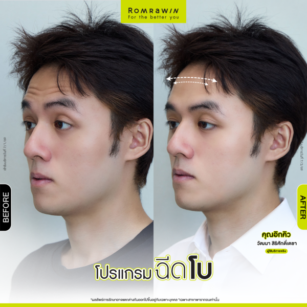 All Review 207 รีวิวโปรแกรมฉีดโบหน้าผาก คุณอิกคิว