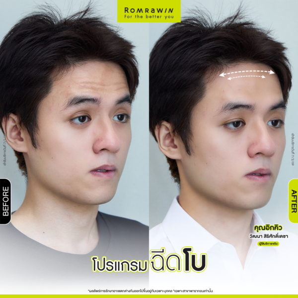 All Review 208 รีวิวโปรแกรมฉีดโบหน้าผาก คุณอิกคิว