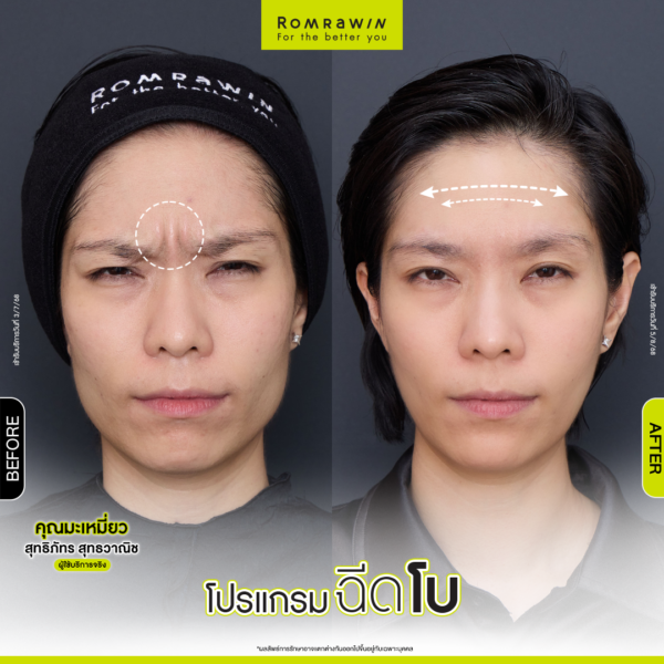 All Review 217 รีวิวโปรแกรมฉีดโบขมวดคิ้ว คุณมะเหมี่ยว