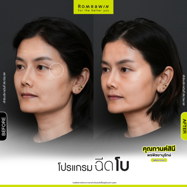 All Review 202 รีวิวโปรแกรมฉีดโบหางตา คุณกานต์สินี