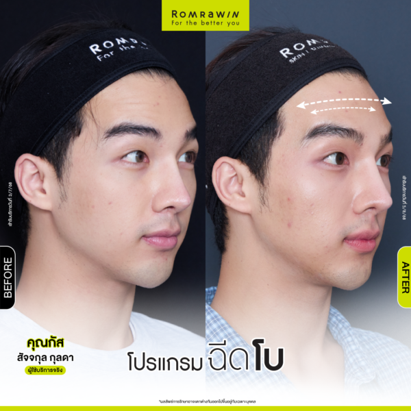 All Review 210 รีวิวโปรแกรมฉีดโบหน้าผาก คุณกัส