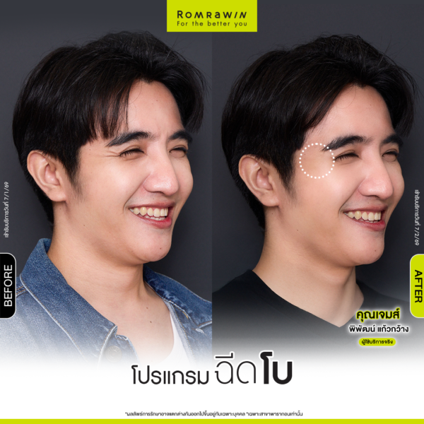 All Review 203 รีวิวโปรแกรมฉีดโบหางตา คุณเจมส์