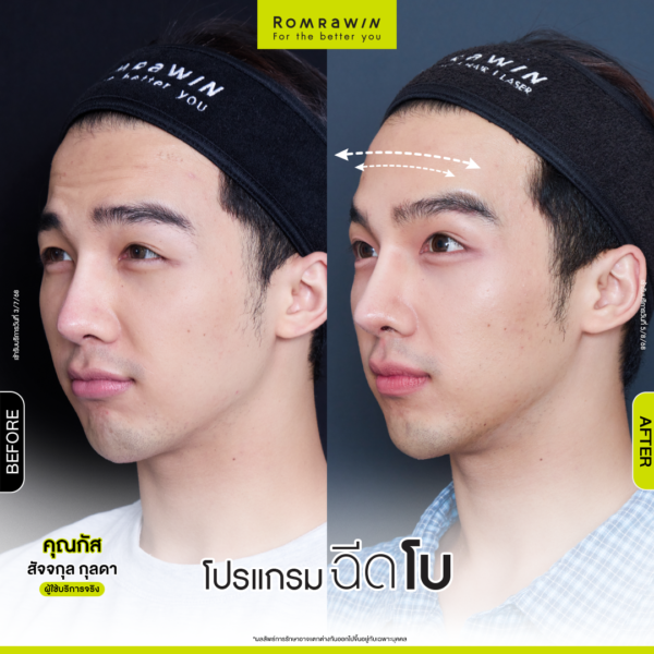 All Review 211 รีวิวโปรแกรมฉีดโบหน้าผาก คุณกัส