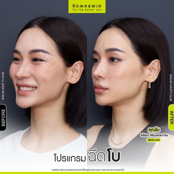 All Review 204 รีวิวโปรแกรมฉีดโบหางตา คุณโม