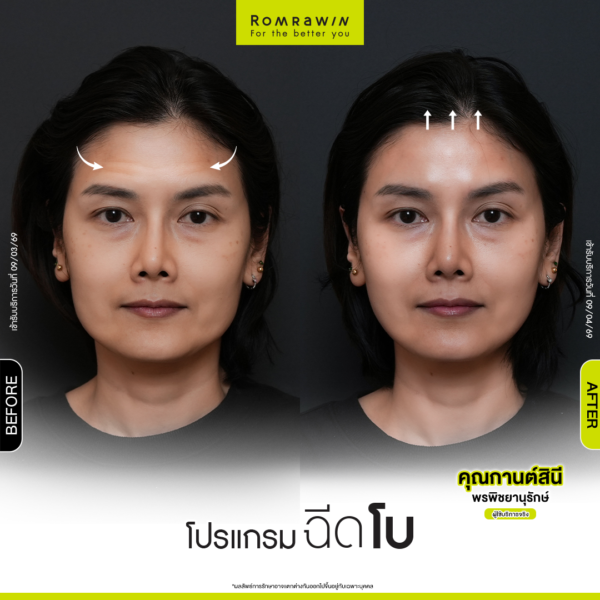 All Review 212 รีวิวโปรแกรมฉีดโบหน้าผาก คุณกานต์สินี